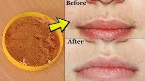 home remedy to remove upper lip hairs