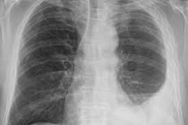 Usually, this cancer is found in the lining of the lungs and th. 123k Paid Out In Mesothelioma Compensation Channel 103