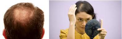 zinc hair loss growth my hair doctor