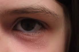 what causes dry eyelids blepharitis
