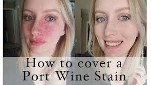port wine stain birthmark