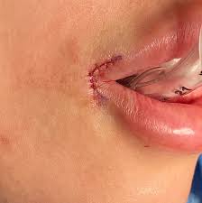 pennant corner of mouth lift