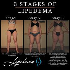 learn about lipedema nodules and how to