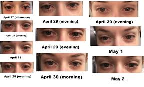 the mysterious eye rash allergy