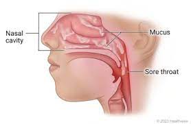 sore throat caused by postnasal drip