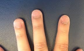 derm dx rough ridged fingernails and