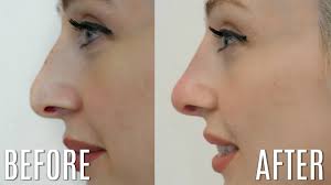 non surgical rhinoplasty carly musleh