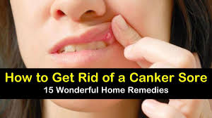 15 canker sore relief remes that work