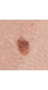 Signs Of Skin Cancer This Skin Check Can Save Your Life