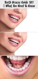 You know your braces are going to give you that straighter, more beautiful smile that you have always wanted, but the wait can seem interminable while you are wearing them. How To Know If You Need Braces Reddit All Round Hobby