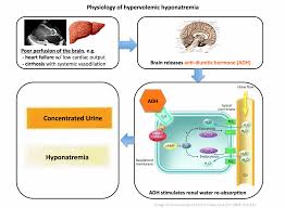 Unconventional Therapies For Hyponatremia Thinking Outside