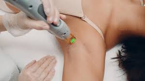 laser hair removal amsterdam and