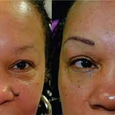 permanent makeup tattoo removal by