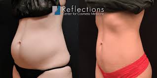 laser liposuction before after photos