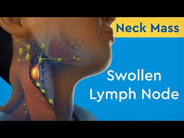 neck m swollen lymph node you