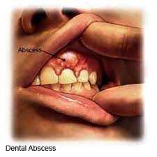 dental abscess what you need to know