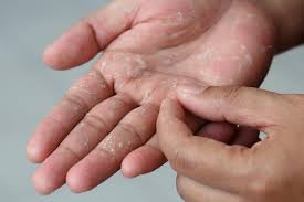 dry hands ling skin on hand