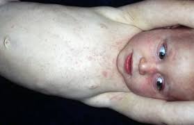 Shortness of breath is more likely to be seen in adults. Roseola Nhs