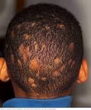 can-fungus-cause-bald-spots