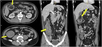 giant submucosal colonic lipoma