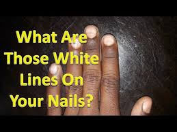 mees lines on nails white lines on
