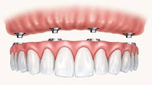 full mouth dental implants pricing guelph
