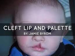 cleft lip by jamie byrom