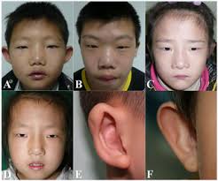 The term 22q11.2 deletion syndrome covers terms once. Characteristic Face A Key Indicator For Direct Diagnosis Of 22q11 2 Deletions In Chinese Velocardiofacial Syndrome Patients