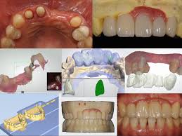 Optical Impression In Restorative Dentistry Intechopen