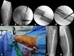 segmental fem shaft fractures
