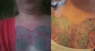 tattoo removal creams do they actually