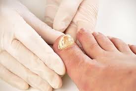 toenail fungus laser treatment most