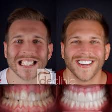 gum contouring dental excellence