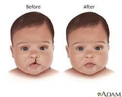 cleft lip repair series aftercare