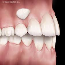 3.8 out of 5 stars. Techniques For Keeping Impacted Canine Teeth From Spoiling Your Smile Kyle Bouhana D D S