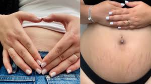 fantastic embrace their stretch marks