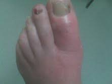dr richard blake swollen big toe