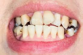 Se sim, então esquecer o seu medo e ser um. Confira As 6 Etapas Do Tratamento Com Aparelho Ortodontico Odontocompany