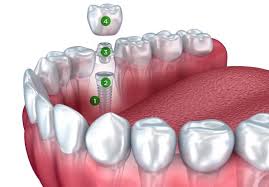 Be sure to speak to your insurance provider to find out about the waiting period and if they cover major dental procedures such as implants. Everything You Wanted To Know About Dental Implants Delta Dental