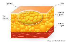 csa surgical center lipoma