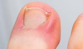avoid ingrown toenails