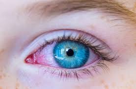 what can cause red eyes in a child