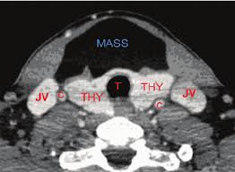 ct scan showing giant anterior neck