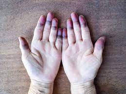 peripheral cyanosis blue hands and