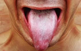 white tongue causes should you worry