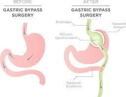 gastric byp versus gastric sleeve