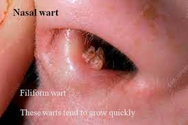 and common warts pictures on