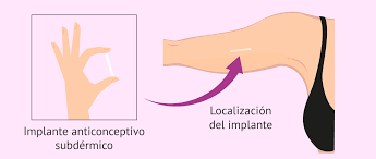 Conocido como pellet, consiste en una varilla metálica diminuta que se inserta bajo la piel del brazo de la mujer, donde. El Implante Anticonceptivo Subdermico Ventajas Y Desventajas