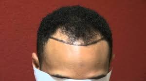 Hair loss genes passed down from either parent might activate at any time after maturity, depending on individual genetics. Four Ways To Minimize Hair Loss Bald Hair Hair Loss Treatment Men Hairline