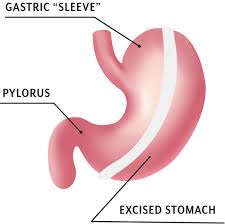 gastric sleeve weight loss surgery in
